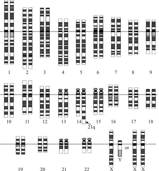 File:Down syndrome translocation.png