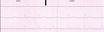 EKG-diagram från en frisk 21-årig man.