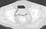 Miniatura per Pneumaturia