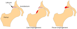 Vorschaubild für Femoro-acetabuläres Impingement