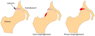 Diagram illustrating the two subtypes of FAI. Femoral acetabular impingement FAI de.svg