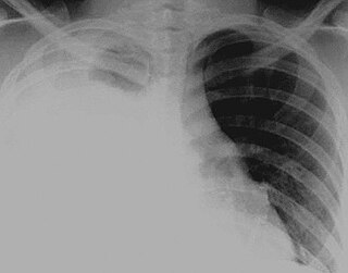 <span class="mw-page-title-main">Hydrothorax</span> Medical condition