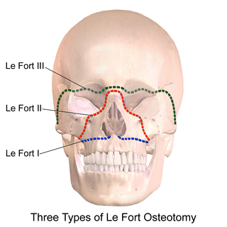 <span class="mw-page-title-main">Le Fort osteotomy</span> Sectioning of the maxilla