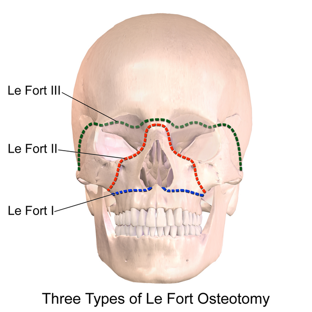 le fort fracture