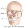 Thumbnail for Le Fort osteotomy