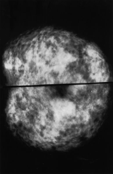 File:Mammogram showing normal dense breasts.jpg
