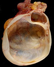 180px-Mucinous_Cystadenoma_of_Ovary.jpg