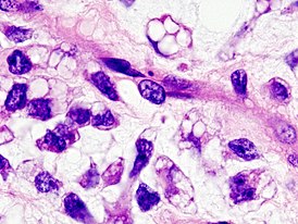 Микрофотография миксоматозной липосаркомы. Окрашено гематоксилином и эозином.