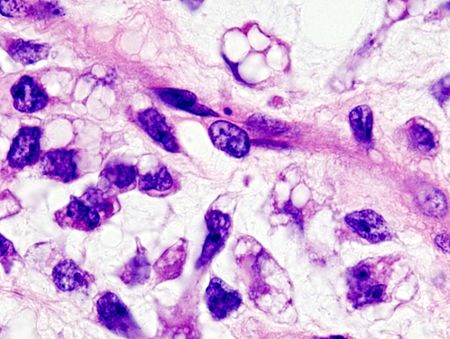 Sarcoma mỡ