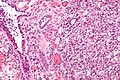 Nephrogenic adenoma - high mag.jpg