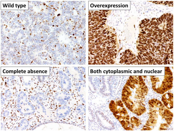 Different patterns of p53 expression in endometrial cancers