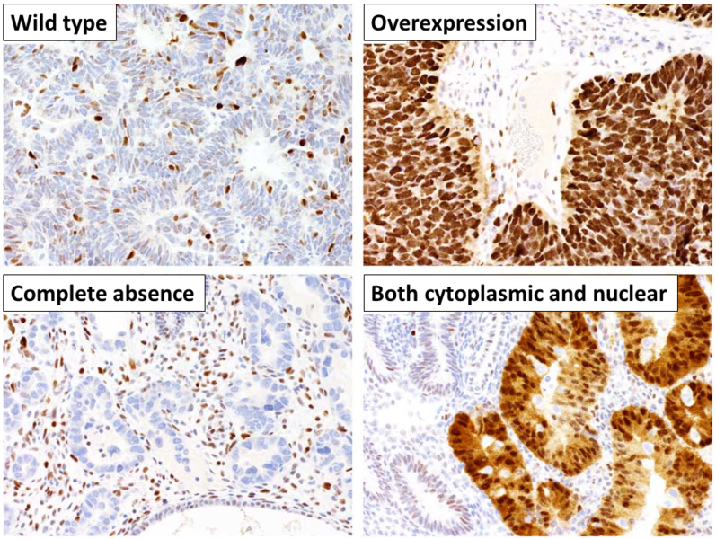 File:Patterns of p53 expression.png