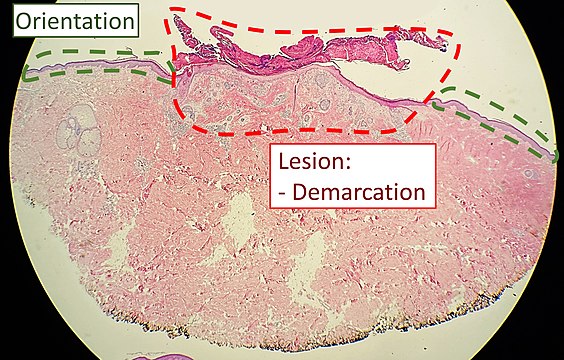 Orientation (lowest magnification): In this case oriented by the skin surface (green). A lesion is seen (red) and its demarcation can be discerned (diffuse in this case)