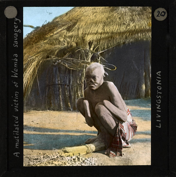 File:"A mutilated victim of Wemba savagery, Livingstonia", ca.1910 (imp-cswc-GB-237-CSWC47-LS4-1-020).jpg