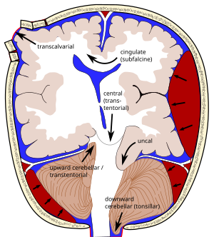 Brain herniation types-2.svg