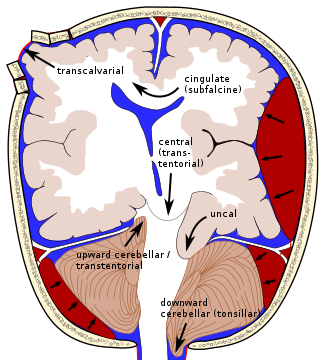 Types of brain herniation.[5]