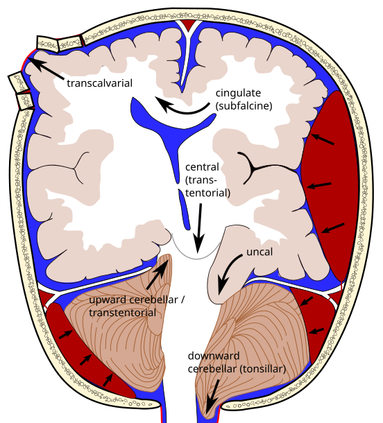 1. Uncal (transtentorial) temporal lobe shifts over free tentorial edge = compresses brainstem

2. Central - brainstem shifted downward

3. Subfalcine - cingulate gyrus shifts under falx cerebri

(4. Transcalvarial)

5. Upward - posterior fossa protrudes 