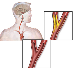 stenosis.png carotidienne