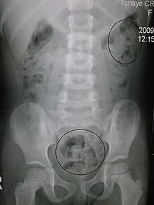 Constipation in a young child as seen by KUB X-ray. Circles represent areas of fecal matter (stool is opaque white (not to be confused with white opaque skeletal mass and muscle mass) surrounded by black bowel gas Constipation.JPG