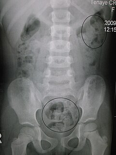 Constipation Bowel dysfunction