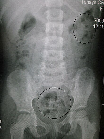 Constipation in a young child seen on X-ray. Circles represent areas of faecal matter (stool is white surrounded by black bowel gas).