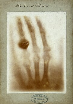 Impression de l'une des premières radiographies de Wilhelm Röntgen de la main gauche de son épouse, présentée à l'institut de physique de l'université de Fribourg le 1er janvier 1896. (définition réelle 3 391 × 4 876)