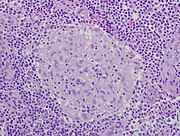 Granuloma without necrosis in a patient with sarcoidosis