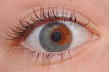 boala ochilor de culori diferite)