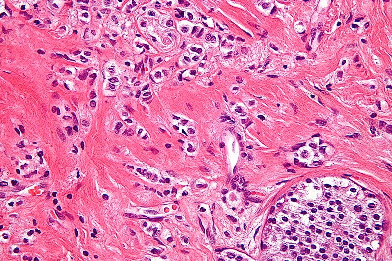 File:Lobular carcinoma - very high mag.jpg