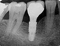 Vignette pour Implant dentaire