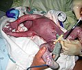 Перерезание пуповины между зажимами (у зажима наложенного со стороны новорождённого)