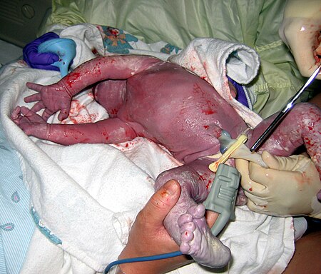 Newborn umbilical suction.jpg