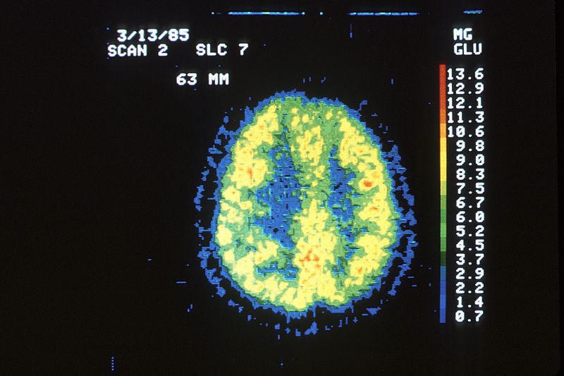 File:Pet scan of a normal brain.jpg