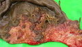 Resected distal part of fetal sac, with attached placenta