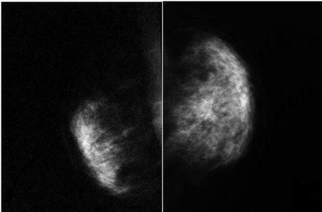 Mammogram showing absence of the pectoralis major muscle and distortion on the left side. Right side is normal.