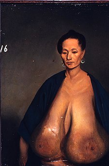 Super Huge Gigantomastia Boobs - Breast hypertrophy - Wikipedia