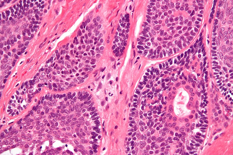 File:Basal cell adenocarcinoma - parotid gland - very high mag.jpg