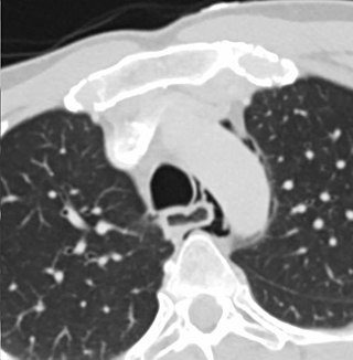 <span class="mw-page-title-main">Esophageal rupture</span> Medical condition