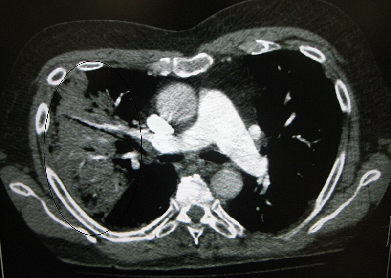 File:CT scan of the chest, demonstrating right-sided pneumonia.jpg