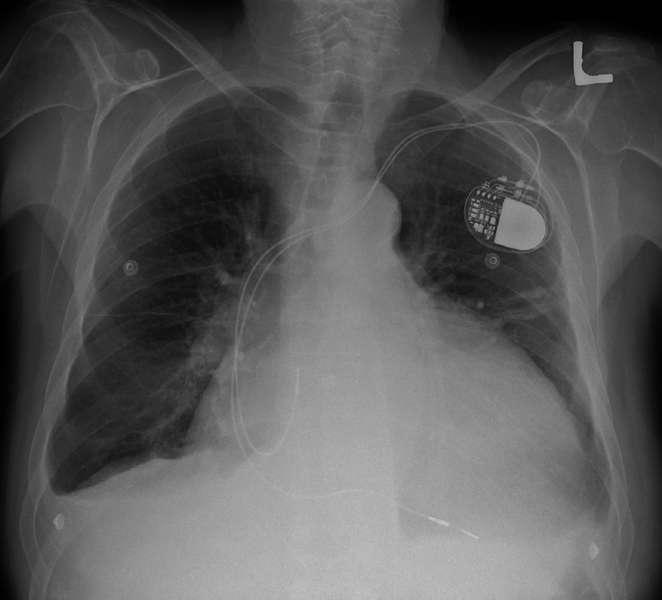 File:Cardiomegally.PNG