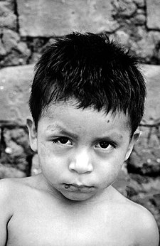 Panamské dítě s Chagasovou chorobou s nateklým pravým okem (znak Romaña)