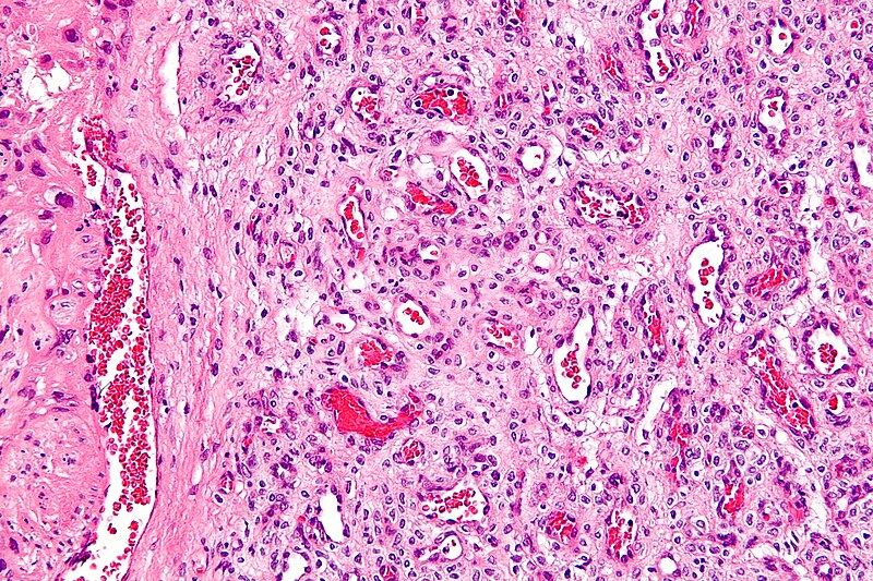 File:Chorangioma - high mag.jpg