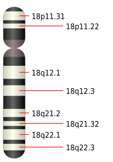 Edwards syndrome Chromosomal disorder in which there are three copies of chromosome 18