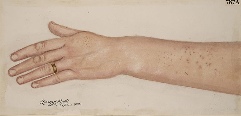 File:Darier's disease affecting the arm Wellcome L0061917.jpg