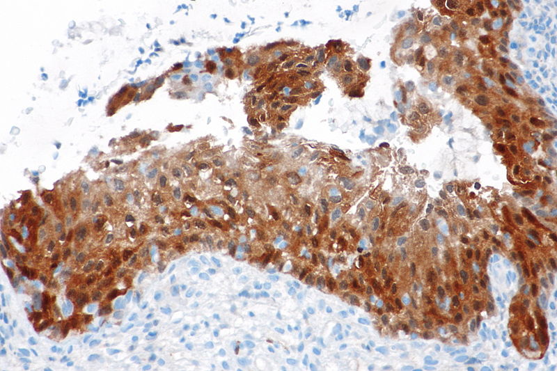 File:High-grade squamous intraepithelial lesion - p16 -- high mag.jpg