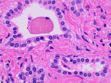 Histopathology of a bile duct hamartoma, high magnification.jpg