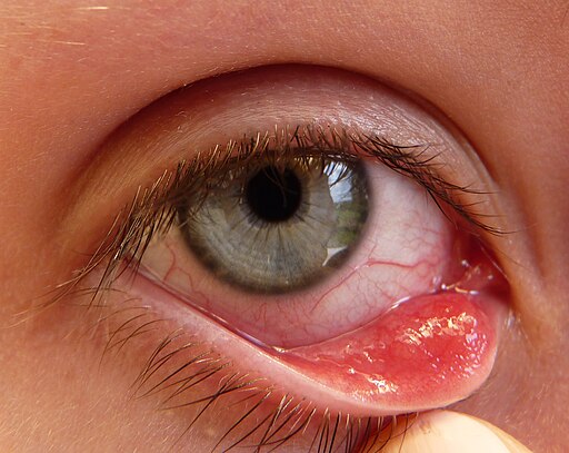 Hordeolum -A stye inside the eyelid