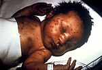 Infant with skin lesions from congenital rubella.jpg