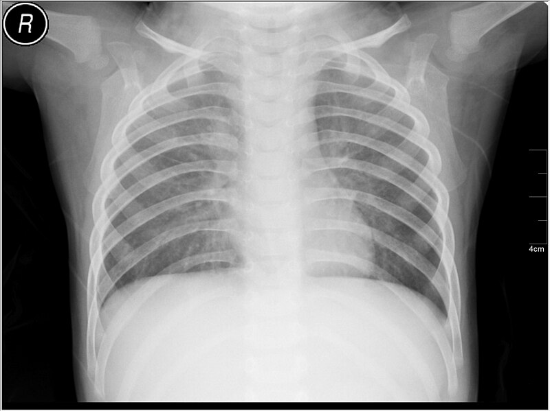 File:Medical X-Ray imaging BPJ03 nevit.jpg