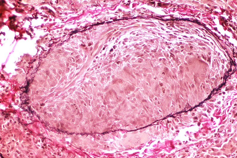 File:Sarcoidosis - Granulomatous phlebitis - Elastic tissue stain (6128090641).jpg